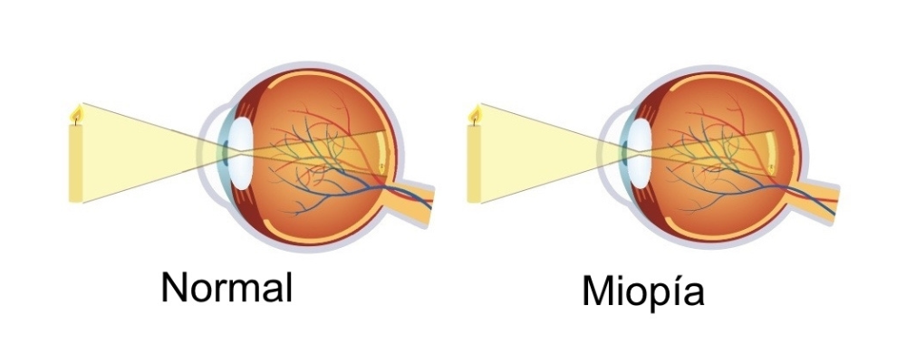 Aquí tenemos dos ojos, el de la izquierda enfoca de forma normal loa vela